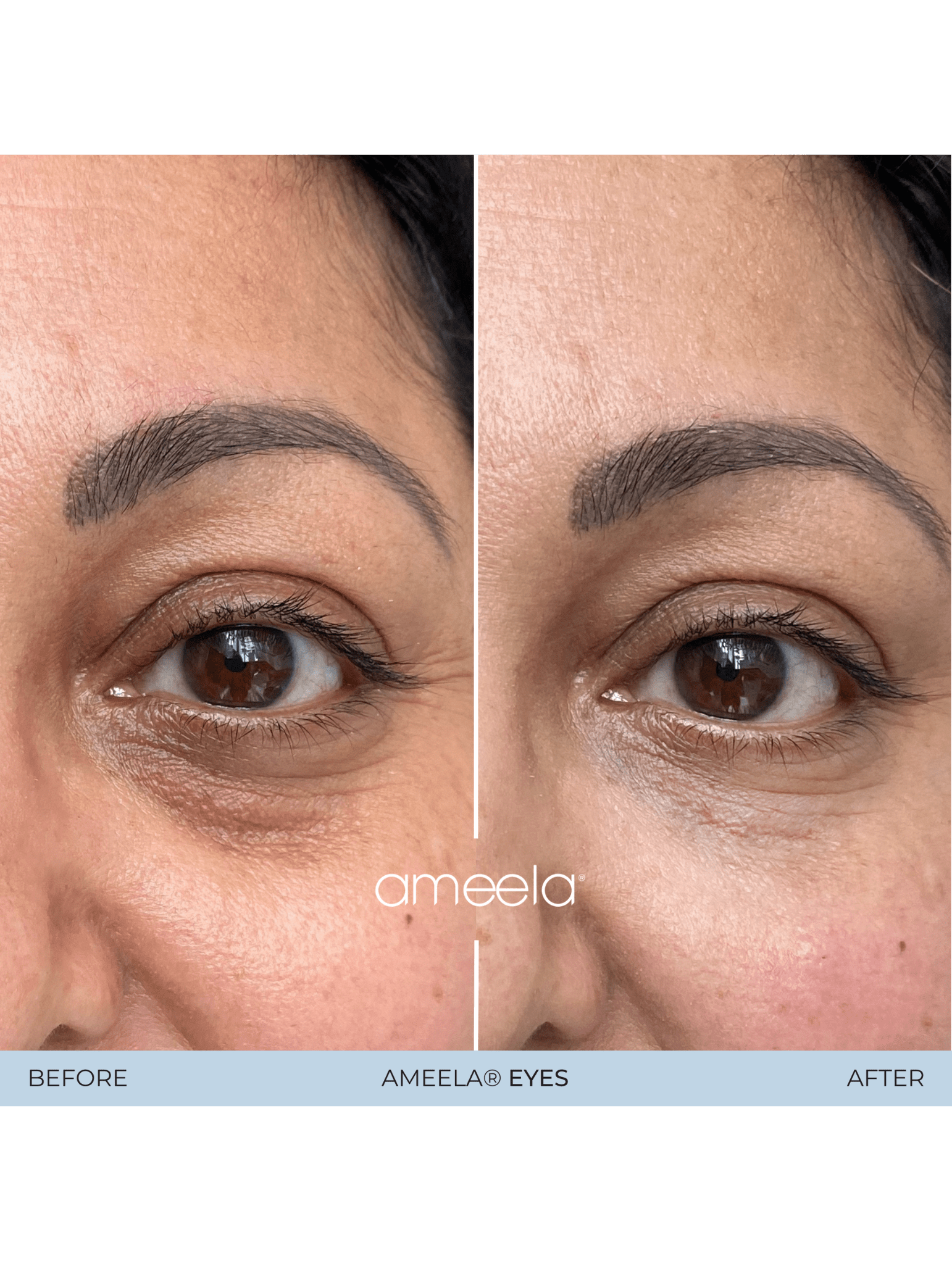 Before and after treatment with Ameela Eyes 