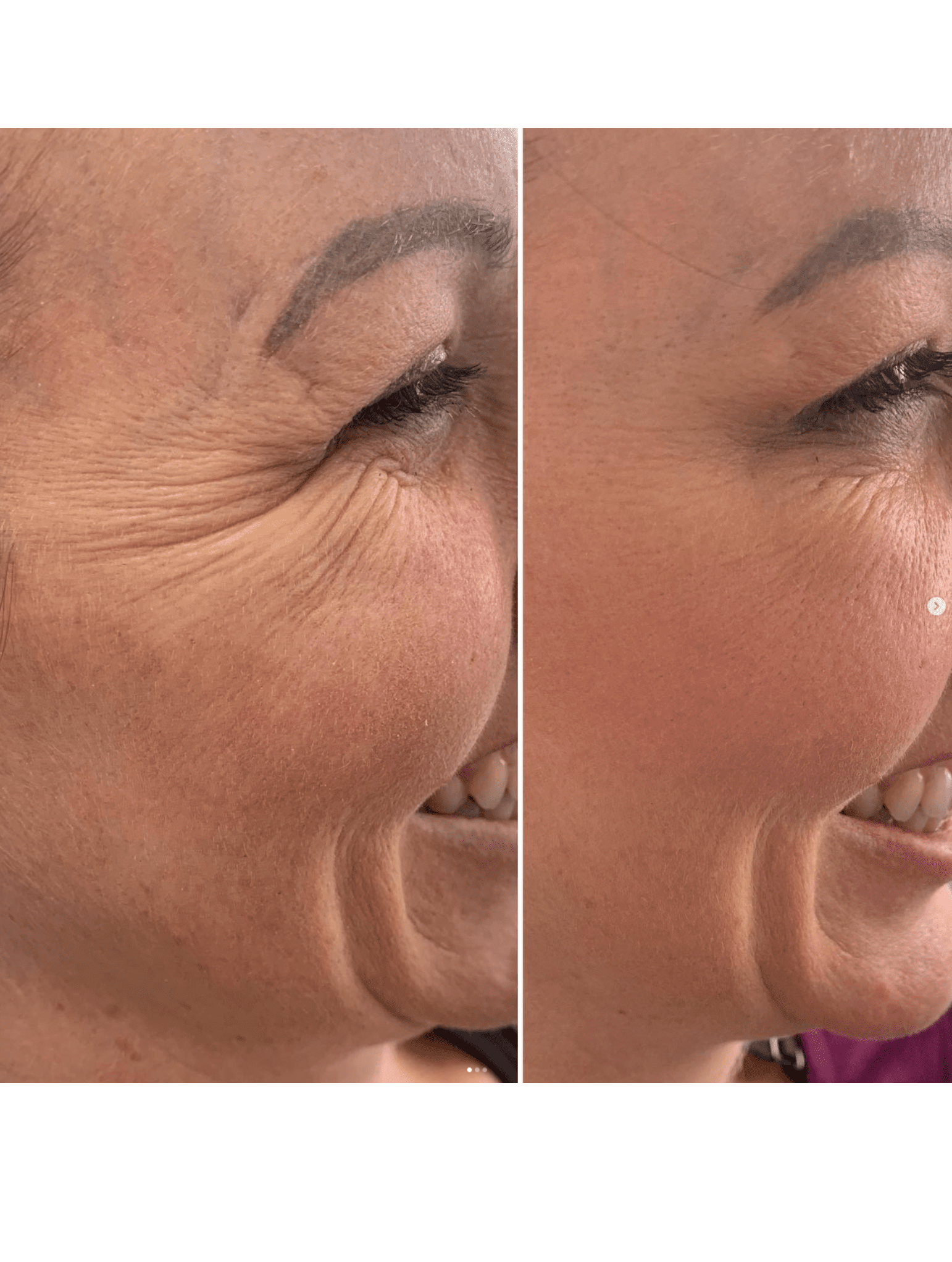 Anti-wrinkle injection results female eye area