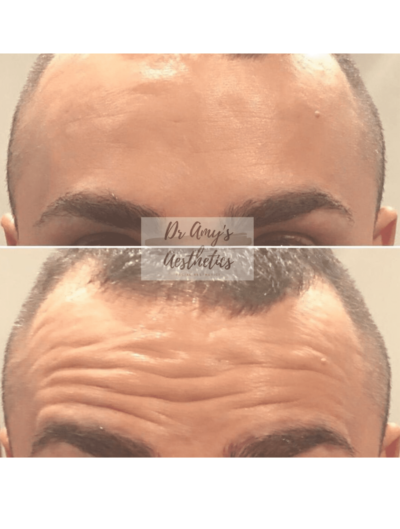 Anti-wrinkle injection results male forehead