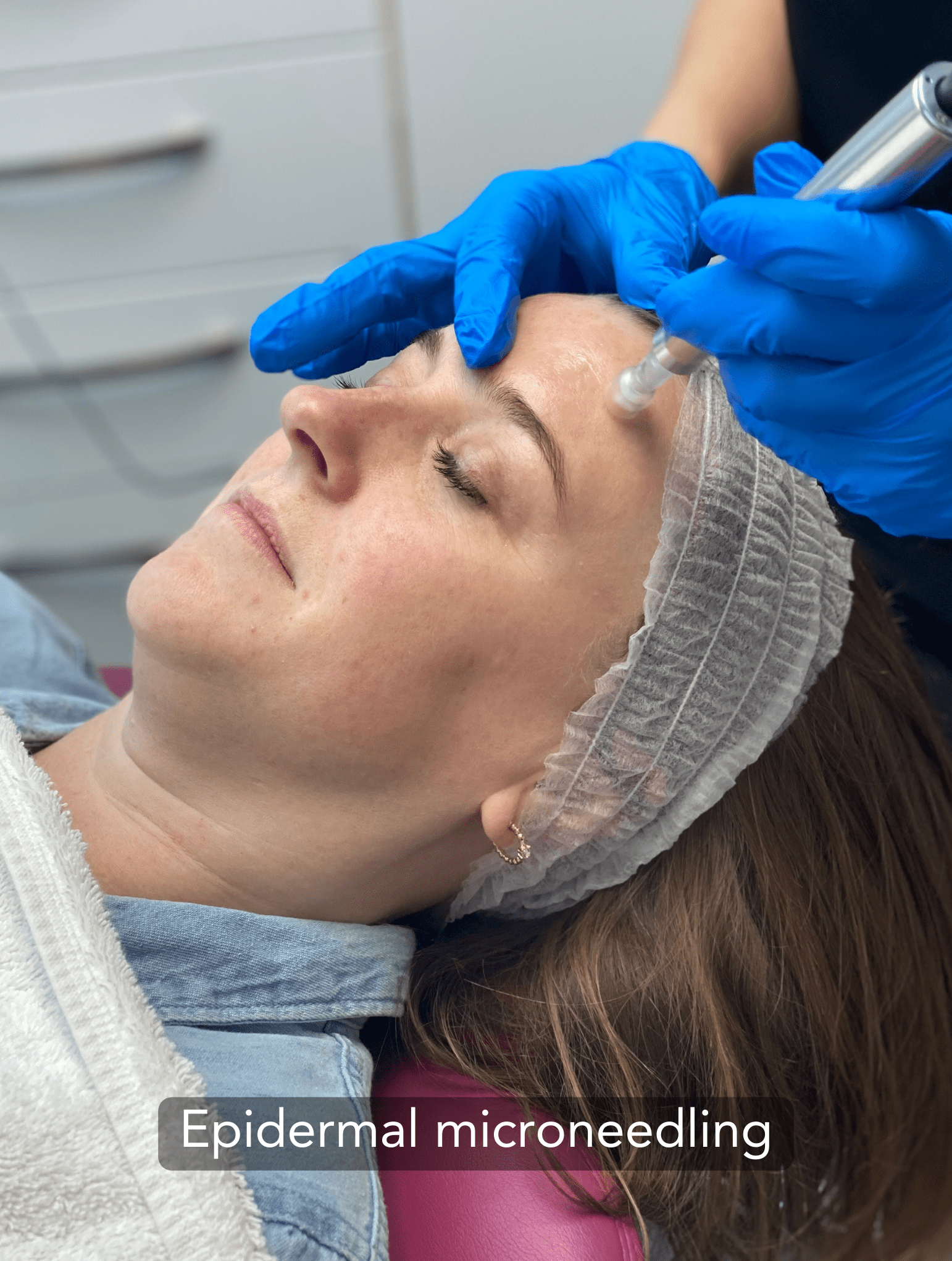 Epidermal microneedling treatment being performed