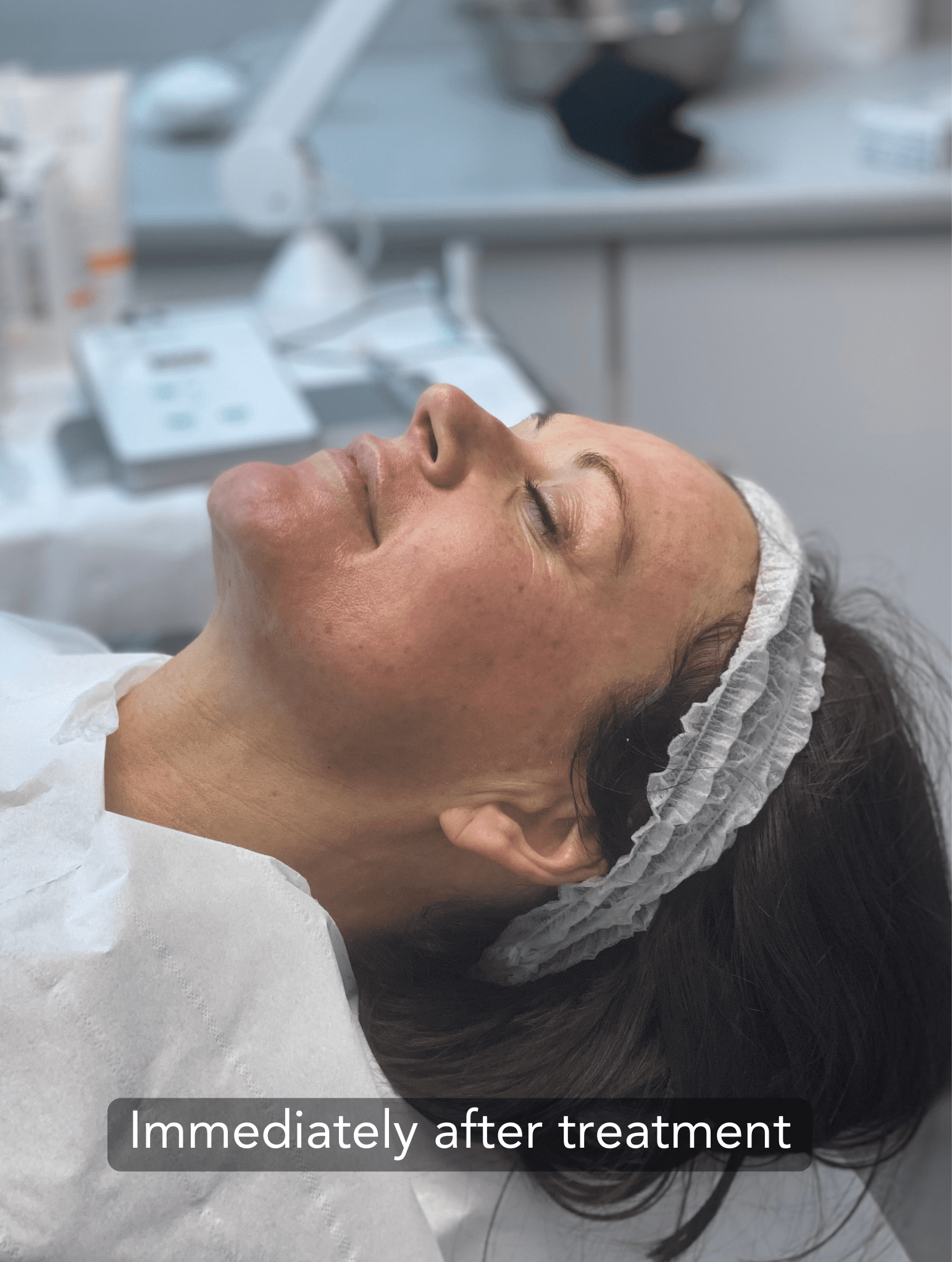 Skin mmediately after microneedling treatment