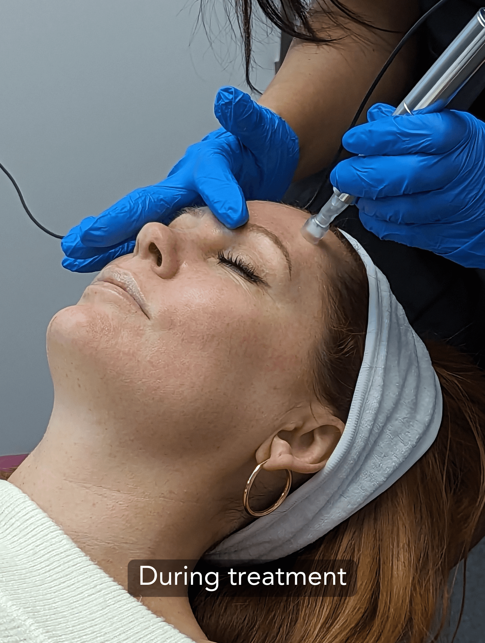 Microneedling treatment on the forehead