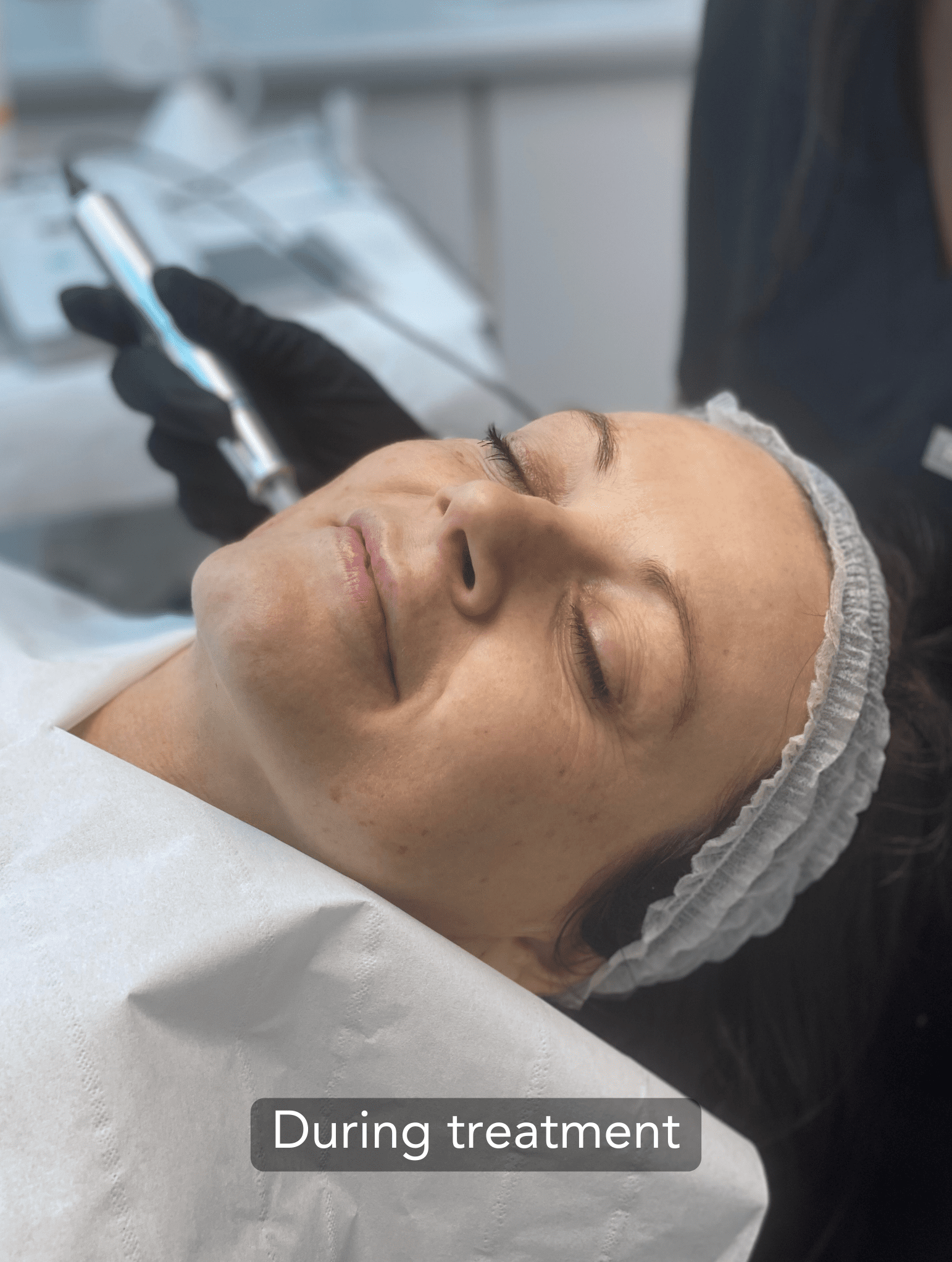 Microneedling treatment on the cheek