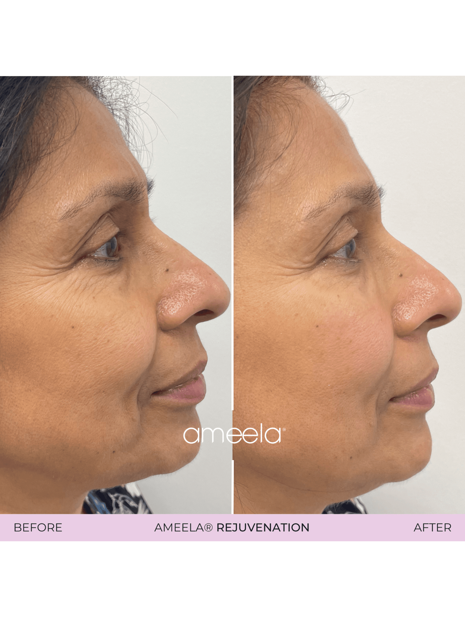 Before and after treatment with Ameela Eyes 